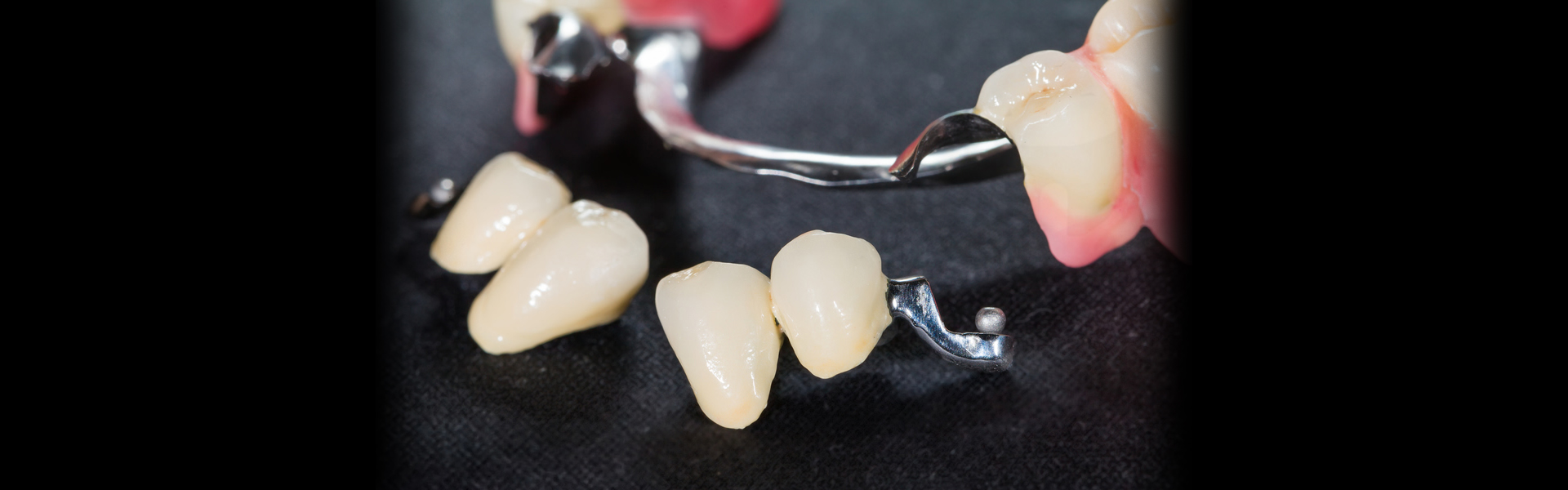 Porcelain Veneers: An Inside Look Into the Procedure, Costs, Pros/Cons, and FAQs